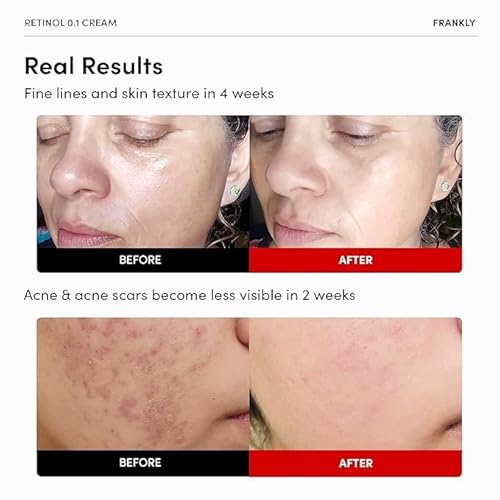 FRANKLY Dark Spot, Wrinkle & Pore Care Set ? Niacinamide Serum + Retinol Night Cream + Peptide Pore Serum | Complete Korean Routine | Skincare Gifts for Women