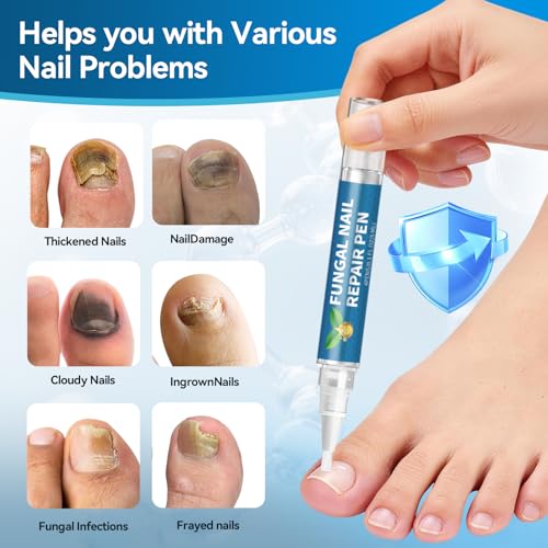 Maximum Strength Toenail Fungus Treatment Pen - 25% Undecylenic Acid, 4 Pens with Nail Files