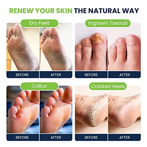 Tea Tree Oil Foot Soak with Epsom Salt Callus Remover for Feet with Extra Strength Gel & Foot Pumice Stone Set - Easy Way to Remove Hard Calluses & Dead Skin Build-Up - Professional at-Home Foot Care