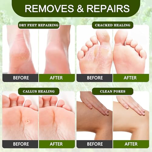 Professional Foot Callus Remover Gel Kit for Smooth Feet