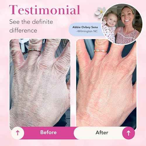 Theraplex Clear Emollient Lotion (8 oz) - No Parabens or Preservatives, Noncomedogenic and Hypoallergenic, Fragrance Free, Dermatologist recommended - National Eczema Association Seal of Acceptance