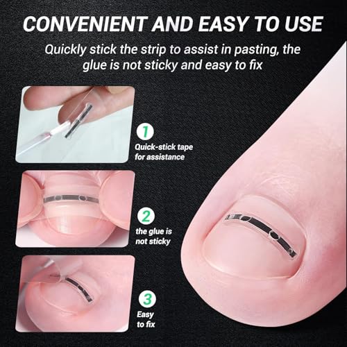 Ingrown Toenail Treatment Kit - Titanium Alloy Curved Nail Repair