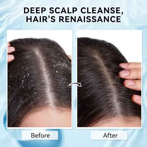 Scalp Scrub with Scalp Scrubber, Dry itchy Scalp & Dandruff Treatment, Scalp Exfoliator, Deep Cleans, Gentle Formula , 8.45 oz