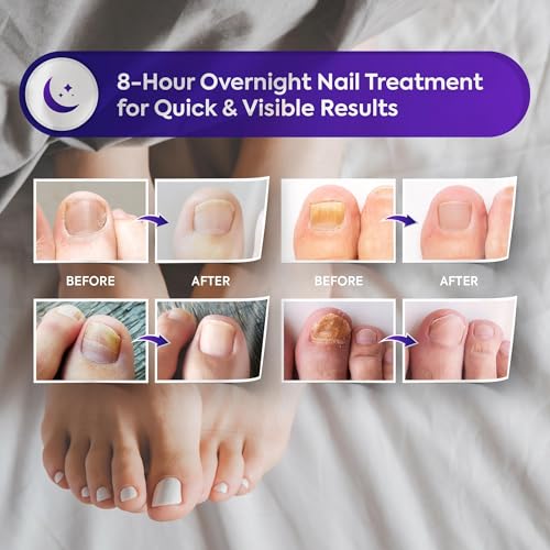 Natural Vine Toenail Fungus Treatment Patches - Extra Strength 1% Tolnaftate, 32 Patches for Overnight Renewal