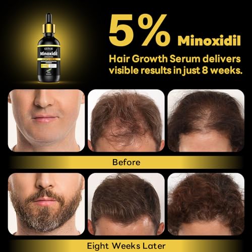 5% Minoxidil Hair Growth Serum for Men & Women with Biotin