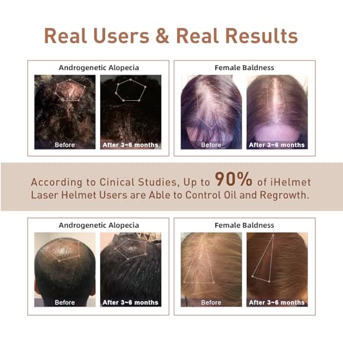 iHelmet Laser Hair Growth Helmet - FDA Cleared LLLT Cap