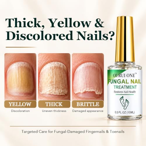 Toenail Fungus Treatment with 25% Undecylenic Acid - Clear Brush-On Nail Care for Thick Yellow Nails