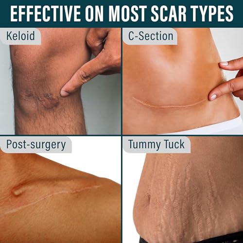 NUVADERMIS Silicone Scar Tape & Overnight Intensive Scar Cream ? Complete Scar Care Duo for Surgical Scars