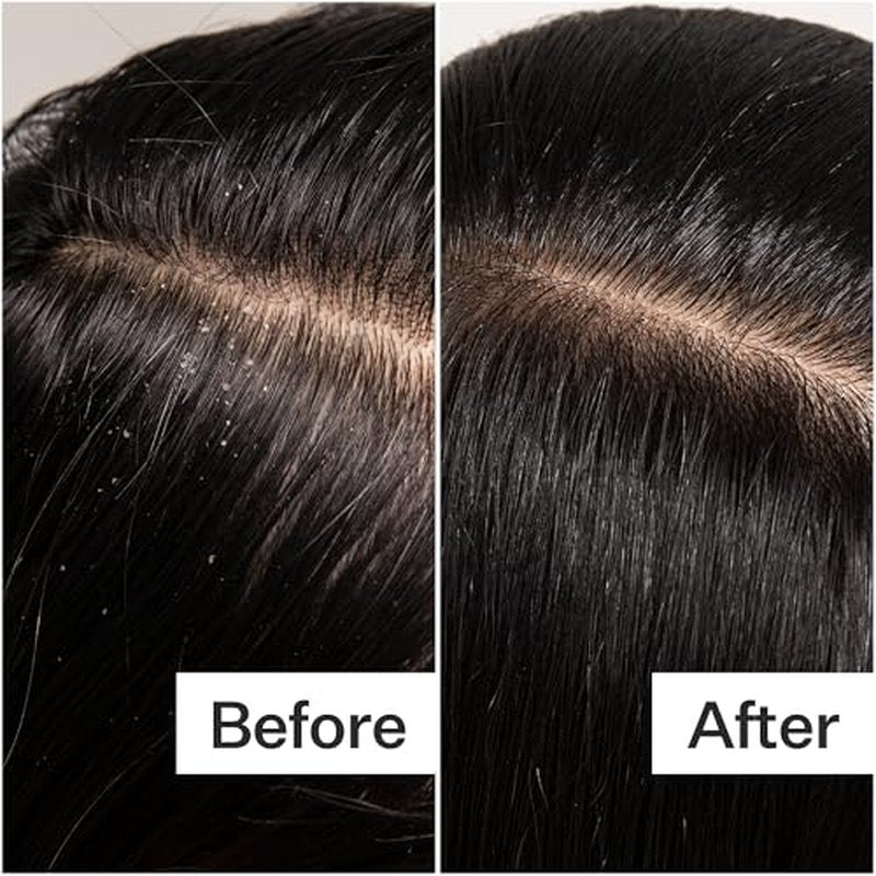 ACT+ ACRE Scalp Detox Oil - Hydrating Treatment for Dry, Itchy Scalp