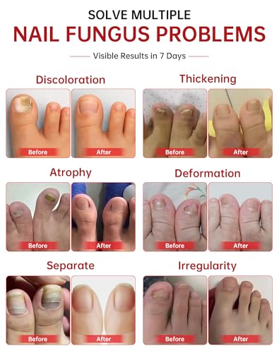 Extra Strength Toenail Fungus Treatment - 25% Undecylenic Acid