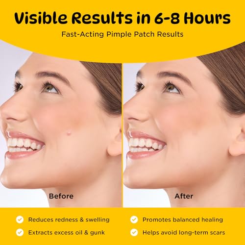 Zit Zap Pimple Patches-Hydrocolloid Acne Spot Patch- 4 Sizes-360 Count. (8mm 10mm 12mm 14mm, 360, Count)