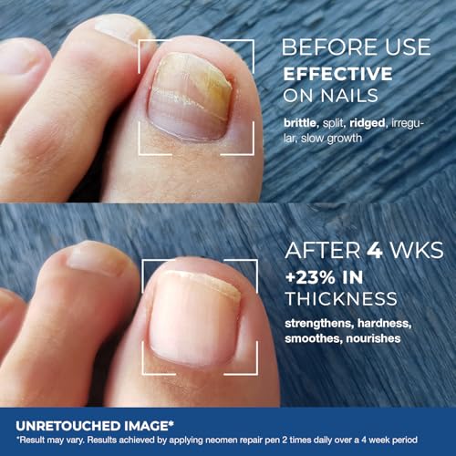 Nail Fungus Pen Treatment for Toenails & Fingernails, 4 Count