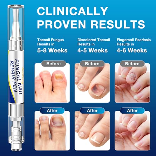 AntiFung Toenail Fungus Treatment Pen - 25% Undecylenic Acid