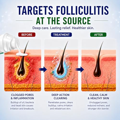 Folliculitis Treatment Cream for Razor Bumps & Ingrown Hairs