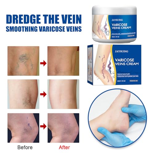 Varicose Veins Relief Cream for Legs ? Soothing, Moisturizing & Circulation Support for Spider Veins & Healthy-Looking Skin ? 2 x 1.76 Oz Tubes