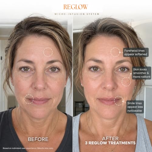 ReGlow Micro-Infusion Serum for Face - Radiance & Firmer Skin, 6 Treatments, 24ml