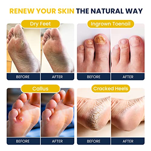 Citrus Detox Foot Soak with Epsom Salts - for Foot Callus, Tea Tree Oil Foot Cream - Moisturizing Athletes Foot Care For Dry Cracked Feet Cream - Heel & Callus Removal