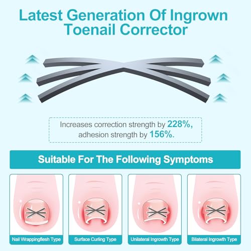 Ingrown Toenail Treatment Kit with Upgraded 6-Angle Shape,Titanium Alloy Ingrown Nail Corrector Tools with 4 Multi-Sizes,Ingrown Toe Nail Relief Remover Strips for Curved Toenail Quick Relief,8Pcs