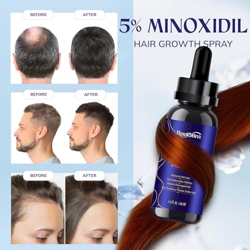 5% Minoxidil Hair Growth Serum for Men & Women