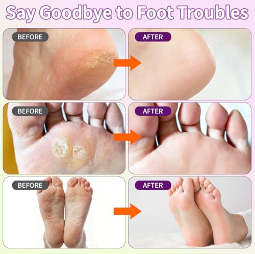 ANKOOY Exfoliating Foot Peeling Mask 6-Pack for Calluses & Dry Heels