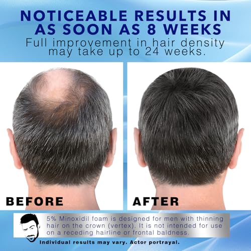 Sefralls 5% Minoxidil Foam for Men's Hair Regrowth - 3-Month Supply