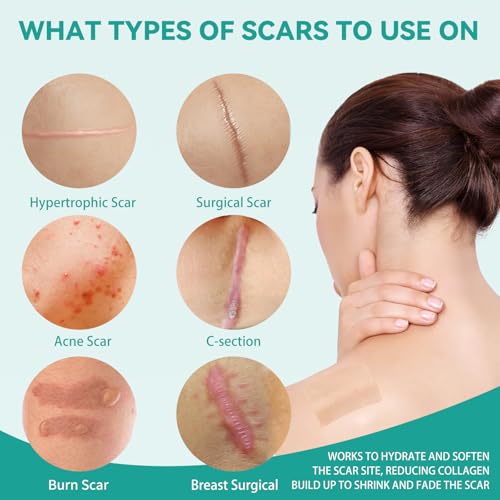 Silicone Scar Tape, Silicone Scar Sheets(1.6"X 160" Roll-4M), Reusable Medical Grade Silicone Tape for Scars, C-Section, Keloid, Acne, Tummy Tuck, Surgical Scars, Light