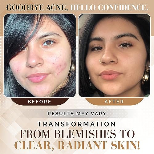 Noir D'or Acne Scar Treatment | Three-Step Extra Gentle Repair Set for Hyperpigmentation, Dark Spot Removal, and Breakouts | Face Skincare