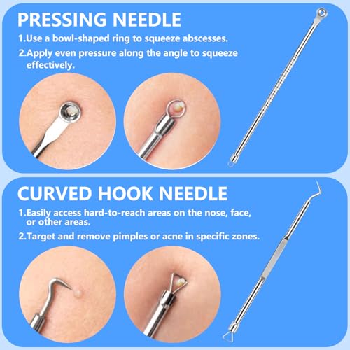 5PCS Blackhead Remover Kit Stainless Steel Comedone Extractors for Acne