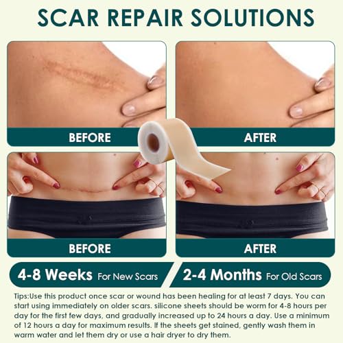 Silicone Scar Tape, Premium Silicone Gel Scar Sheets (1.6"x 60" Roll-1.5M), Reusable Silicone Patches, Soft Silicone Tape for Surgeries Scars, C-Sections, Wrinkles et