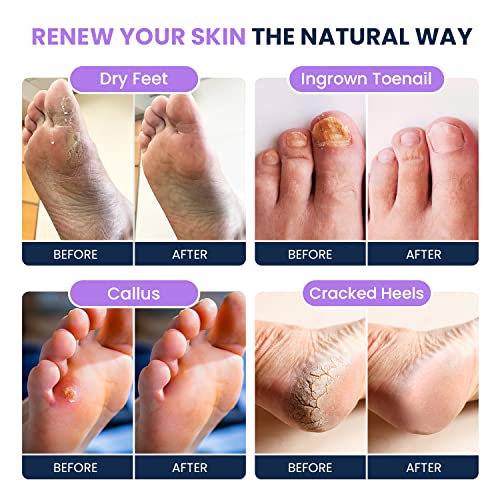 Soothing Lavender Foot Soak with Epsom Salt - Best Toenail Treatment, & Softens Calluses - Soothes Sore & Tired Feet, Moisturizing Athletes Foot Care For Dry Cracked Feet Cream