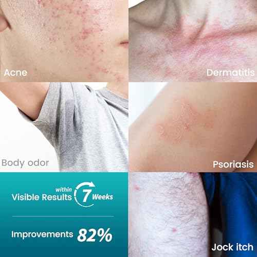 Sulfur & Tea Tree Oil Soap Bar for Seborrheic Dermatitis Acne - Deep Cleanse Bar for Oily, Flaky or Blemish-Prone Skin ? Extra Strength Purifying Formula ? 2 Pack