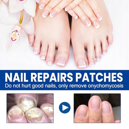 Extra Strength Toenail Fungus Treatment Patches - 60 Pcs Hydrogel