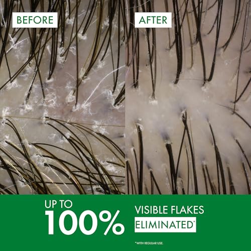 Vichy Dercos Dandruff Shampoo - Antifungal Itchy Scalp Relief