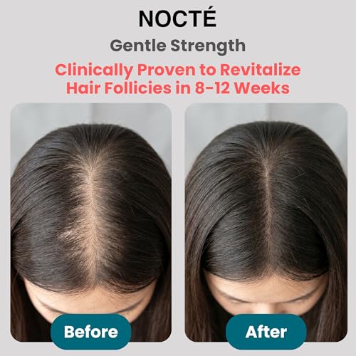 NOCTE 2% Minoxidil Hair Regrowth Serum Spray with Biotin & Caffeine for Thicker Hair
