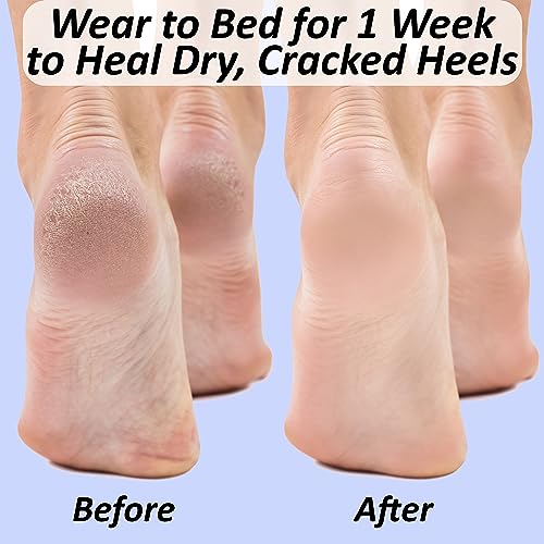 Moisturizing Socks for Cracked Heel Treatment: Heel Socks for Cracked Heel Repair, Silicone Toeless Socks, Spa Gel Socks for Dry Cracked Feet Women, Lotion Moisture Pedicure Socks