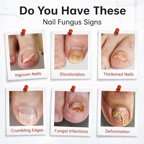 Tolnaftate 1% Antifungal Nail Treatment - Thick Discolored Nails