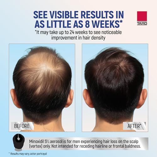 Minoxidil 5% Foam Hair Regrowth Treatment for Men, 3-Month Supply