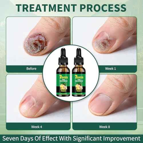 Ginger nail treatment 7 days nail support nail care, 2 pcs nail treatment, Ginger nail growth serum, Ginger cuticle care oil for nails,Cuticle serum for nails