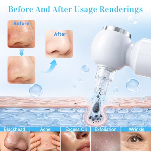 Siangyueglow Blackhead Remover Vacuum with Warm Compress & 6 Heads
