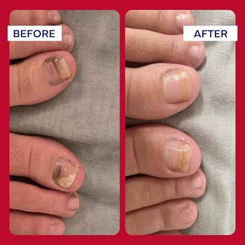 EMUAIDMAX Homeopathic Psoriasis Scalp Treatment Serum ? Natural First Aid Concentrate for Dry, Itchy Scalp Relief and Skin Irritations from Psoriasis, Eczema, and Dermatitis, 1oz