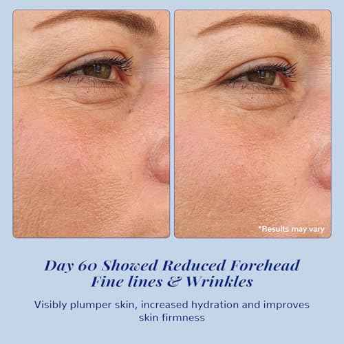 ANAI RUI 10% Argireline Serum+ Matrixyl 3000 Pure Hyaluronic Acid For Face Deep Wrinkle Reducer,Anti-Aging Serum,Peptide Complex Serum1.05 Fl.oz