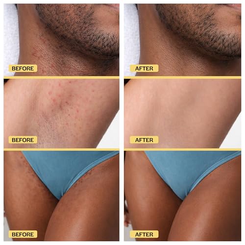 Ingrown Hair Treatment Oil – Soothing After Shave Oil for Men & Women