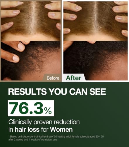 Hair Loss Tonic for Women - Vegan Scalp Serum 150ml
