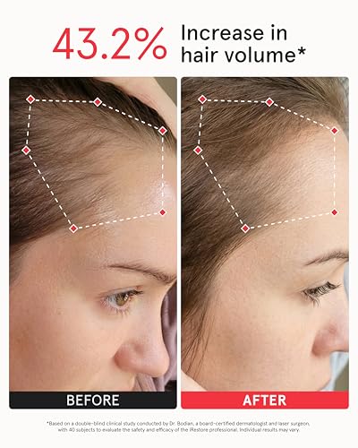 iRestore Pro Laser Hair Growth System - 282 Lasers