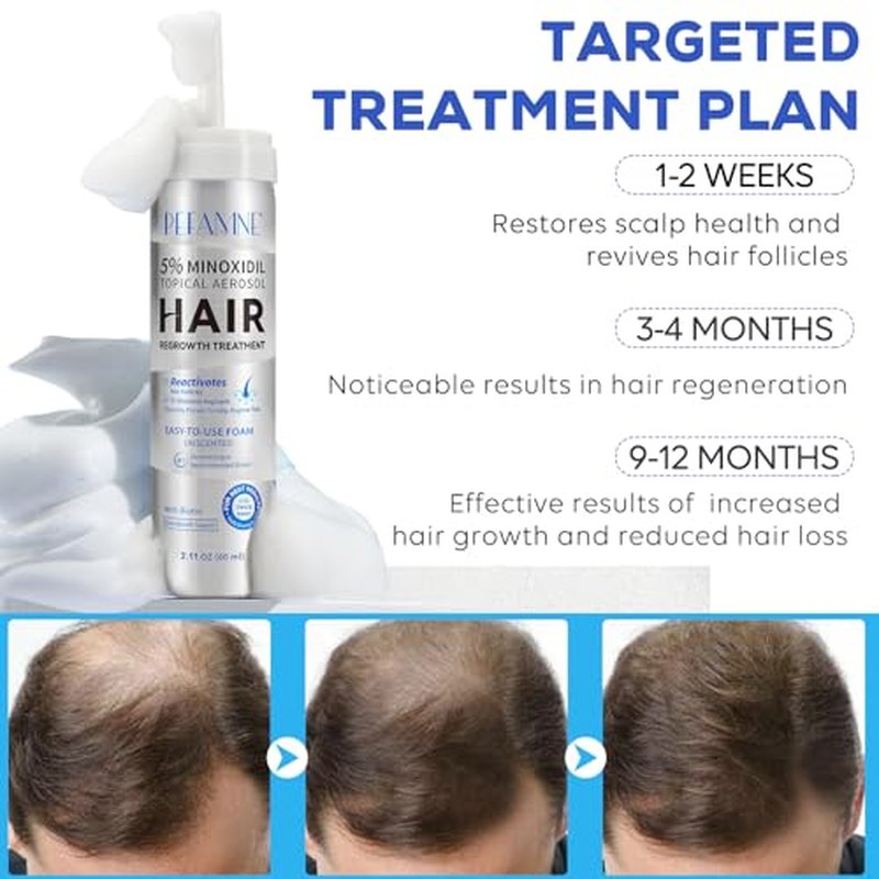 5% Minoxidil Hair Growth Foam for Men & Women