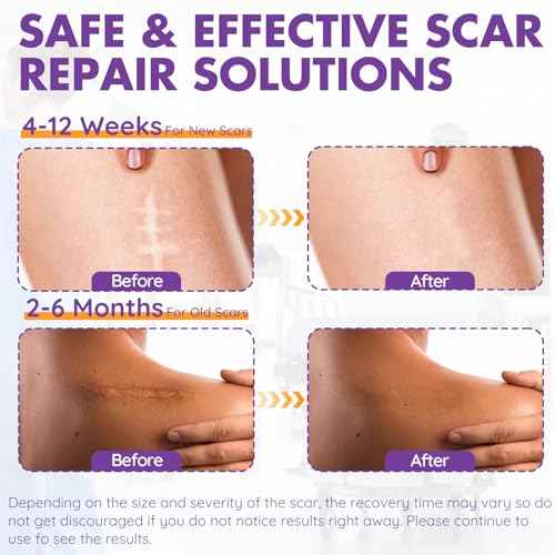 Silicone Scar Sheets, Silicone Scar Tape(1.6"x 79" Roll-2M), Reusable Professional Scar Silicone Strips, Soft Silicone Scar Sheets for Surgical Scars,Keloid,Acne Scars,Burn Scar,C-Section