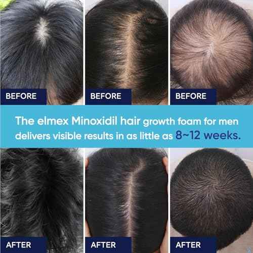5% Minoxidil Foam for Men and Women, Minoxidil for Men Foam for Hair and Beard, Minoxidil for Women Hair Growth (12 Ounce)