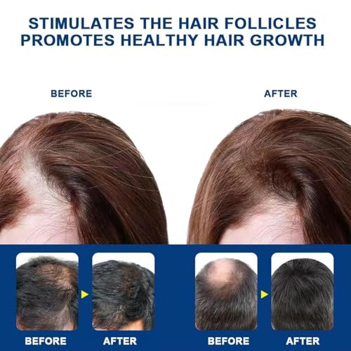 5% Minoxidil Hair Growth Cream for Men & Women