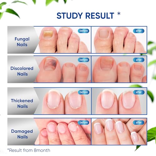 OSIMOON Extra Strength Toenail Fungus Treatment - 10% Undecylenic Acid (30ml)