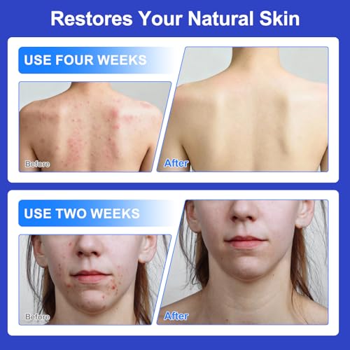 Folliculitis Treatment Cream with 1% Salicylic Acid - Soothes Sensitive Skin, 100g